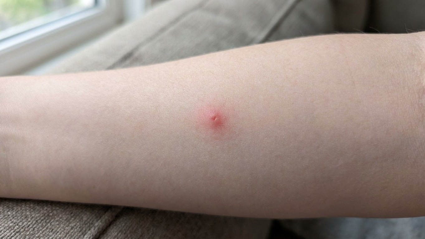 Tiger Mosquito, Tick, or Harvest Mite: How to Identify Your Bite in 6 Hours