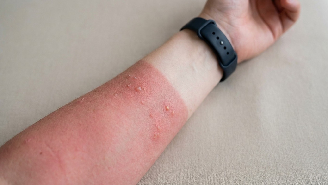 Your Daily Pill Might Be Secretly Burning Your Skin: The Photosensitivity Crisis Nobody Talks About