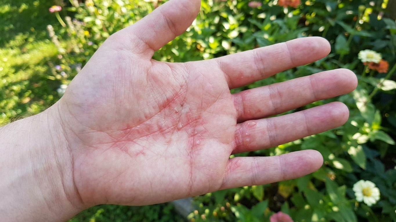 I squeezed limes for cocktails during a sunny garden party: two days later, when I saw what was appearing on my hands, it ...